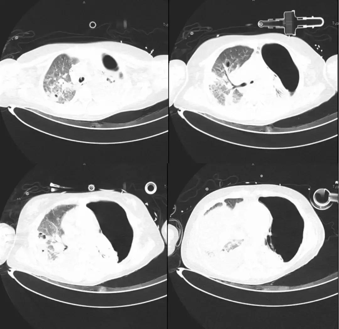 万古霉素用于mrsa的作用机制,万古霉素无效还有什么抗生素可用
