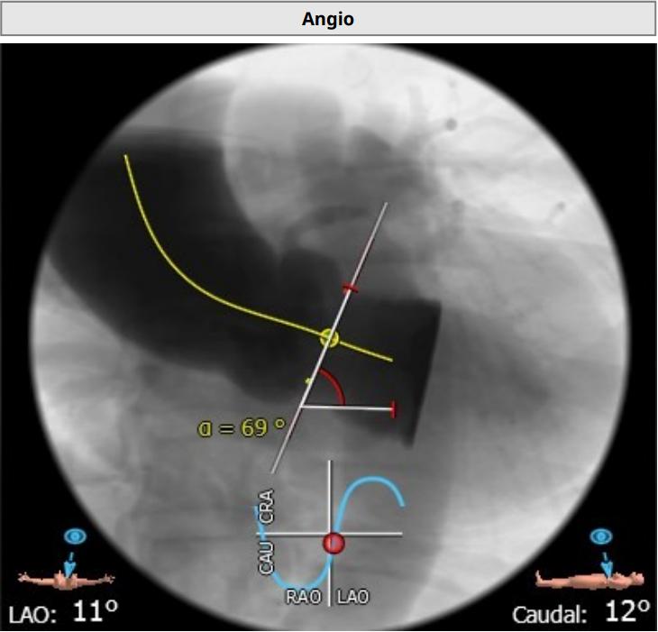 微创人工主动脉瓣膜置换术,微创介入主动脉瓣膜置换术