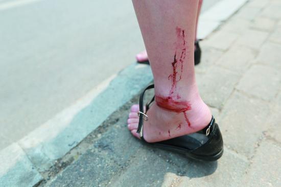 三岁女童手指被压断后续,小孩手指被夹伤需要多久才能恢复