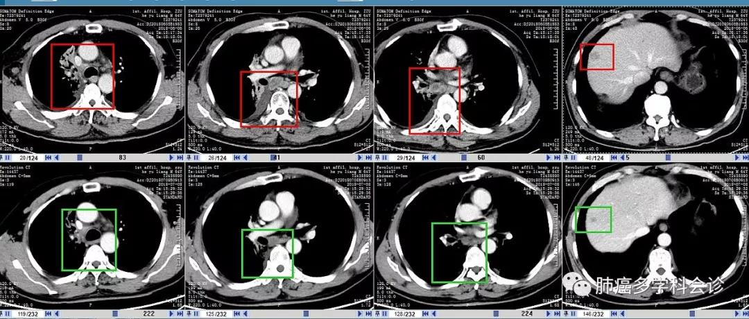 aacr肺癌高发,小细胞肺癌abc临床试验