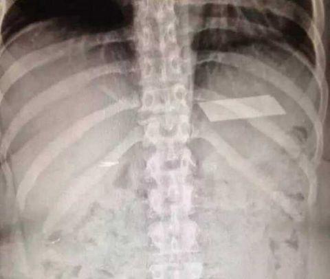 不作死就不会死，看看这些被人类搞进身体里的异物