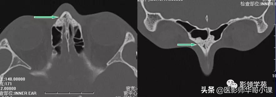 「鼻骨彩图」鼻骨CT解剖及骨折影像学诊断