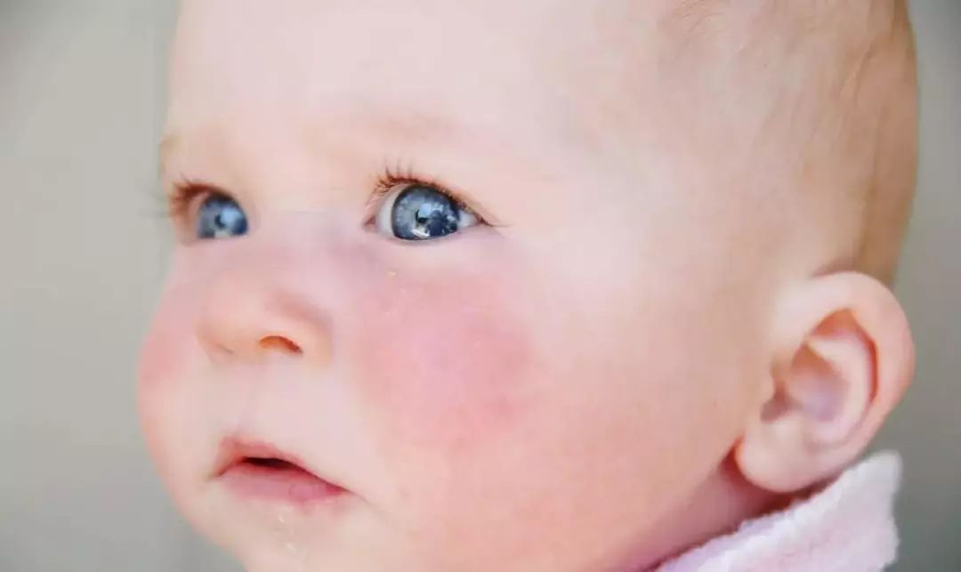 宝宝皮肤干燥如何保湿,宝宝冬季皮肤干燥起皮抹什么