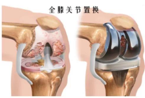 膝关节骨刺疼痛用艾灸有用吗,膝关节骨刺疼痛口服药