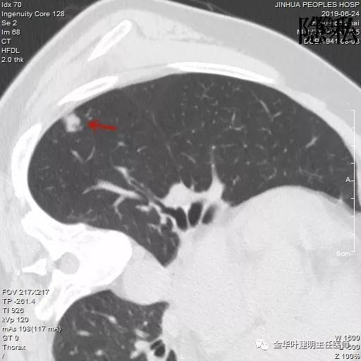 警惕-会是简单的肺大泡吗？
