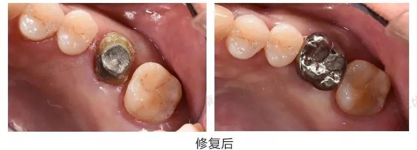 牙齿楔状缺损修复视频,牙齿缺损了可以选择哪些修复方式