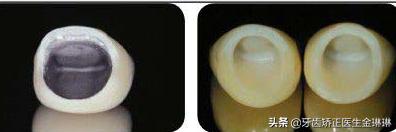 烤瓷牙能用美白牙贴吗,牙贴美白烤瓷牙