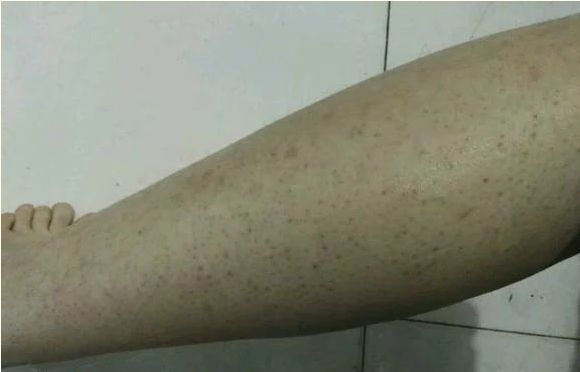 “鸡皮”仙女看过来！教你几招轻松去“鸡皮”