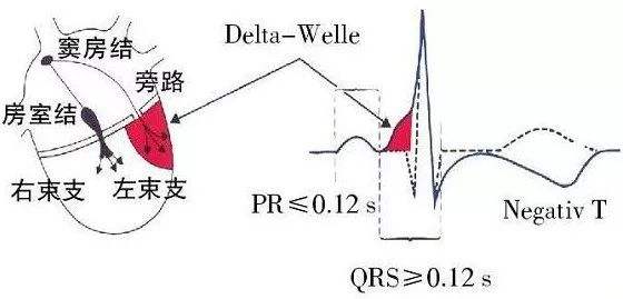 预激综合征是心脏的什么病,预激综合征什么引起的