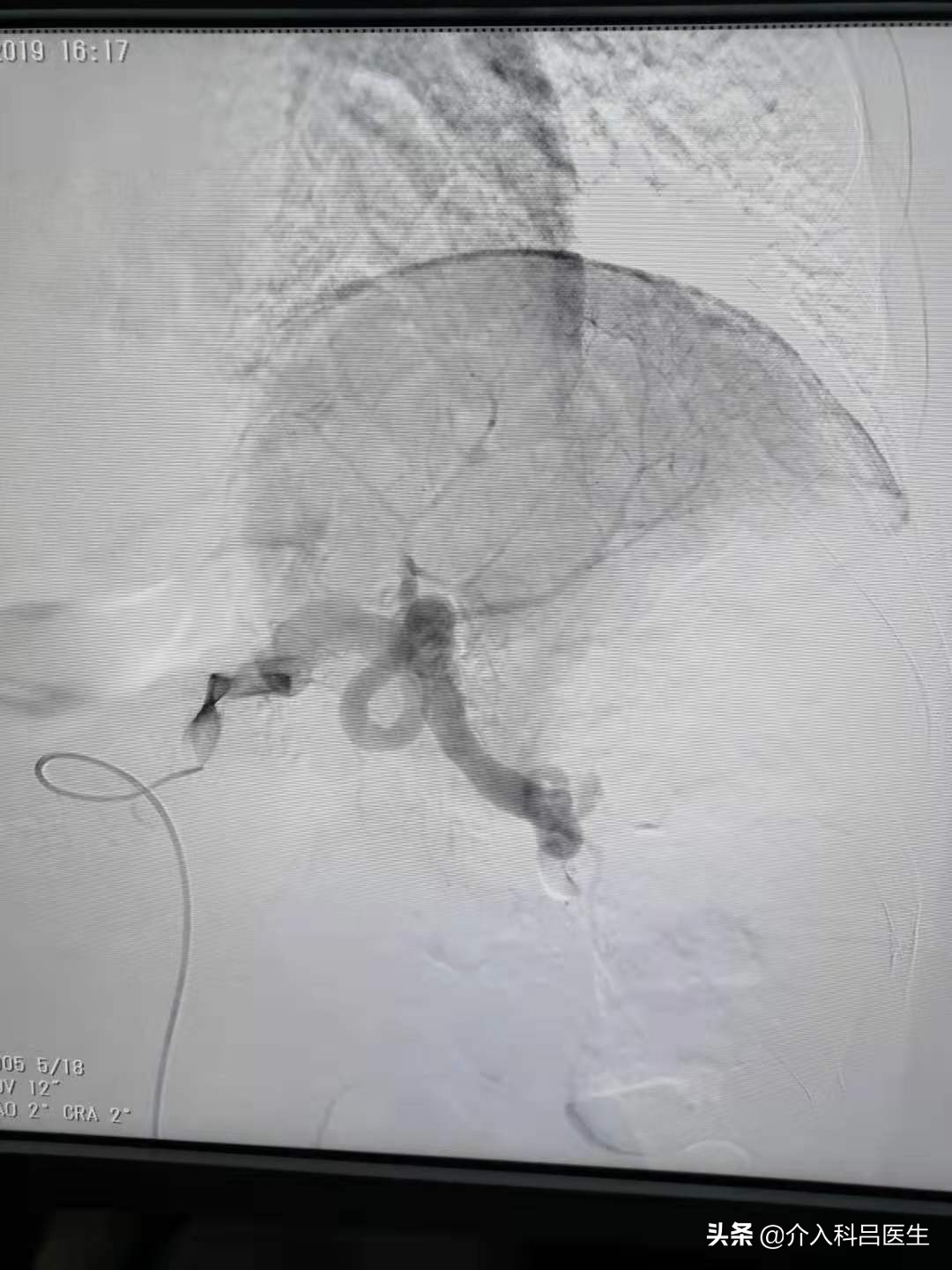 老人静脉曲张皮肤溃烂要动手术吗,老人静脉曲张老烂腿能不做手术吗