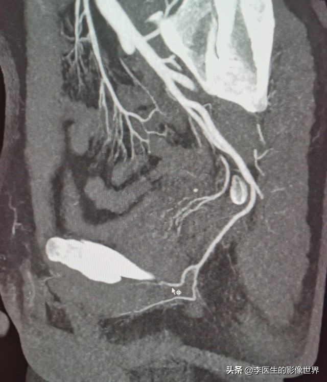 勃起功能障碍,ED之阴部内动脉CT血管成像