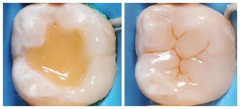 蛀牙补牙了材料老是会掉,为什么我补牙的材料是黑色的