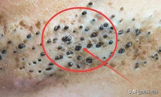长黑头的原因和改善方法,黑头前面长出了白头怎么去掉