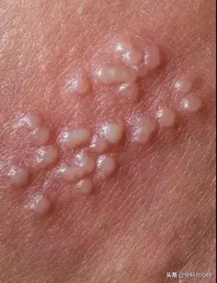 手上手臂起小水泡很痒是怎么回事,手上小水泡抓破了烂了一大片