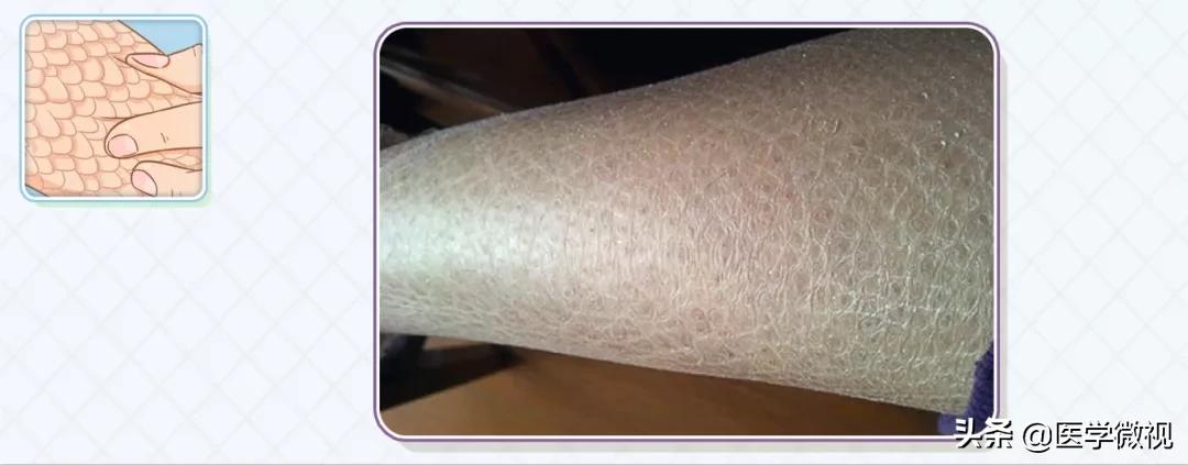 鱼鳞腿皮肤干燥全身起皮怎么办,天气转冷了皮肤脸部干燥脱皮了