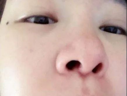 鼻子整形后鼻梁骨增生,鼻子整形增生会疼吗