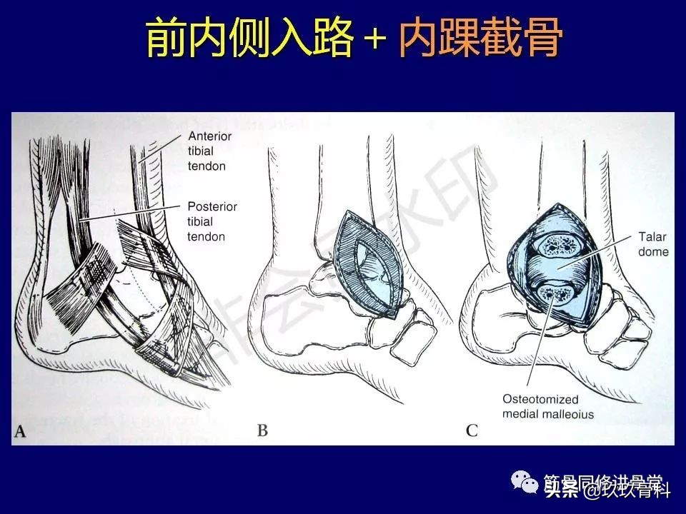 距骨骨折的治疗原则,距骨骨折如何调理