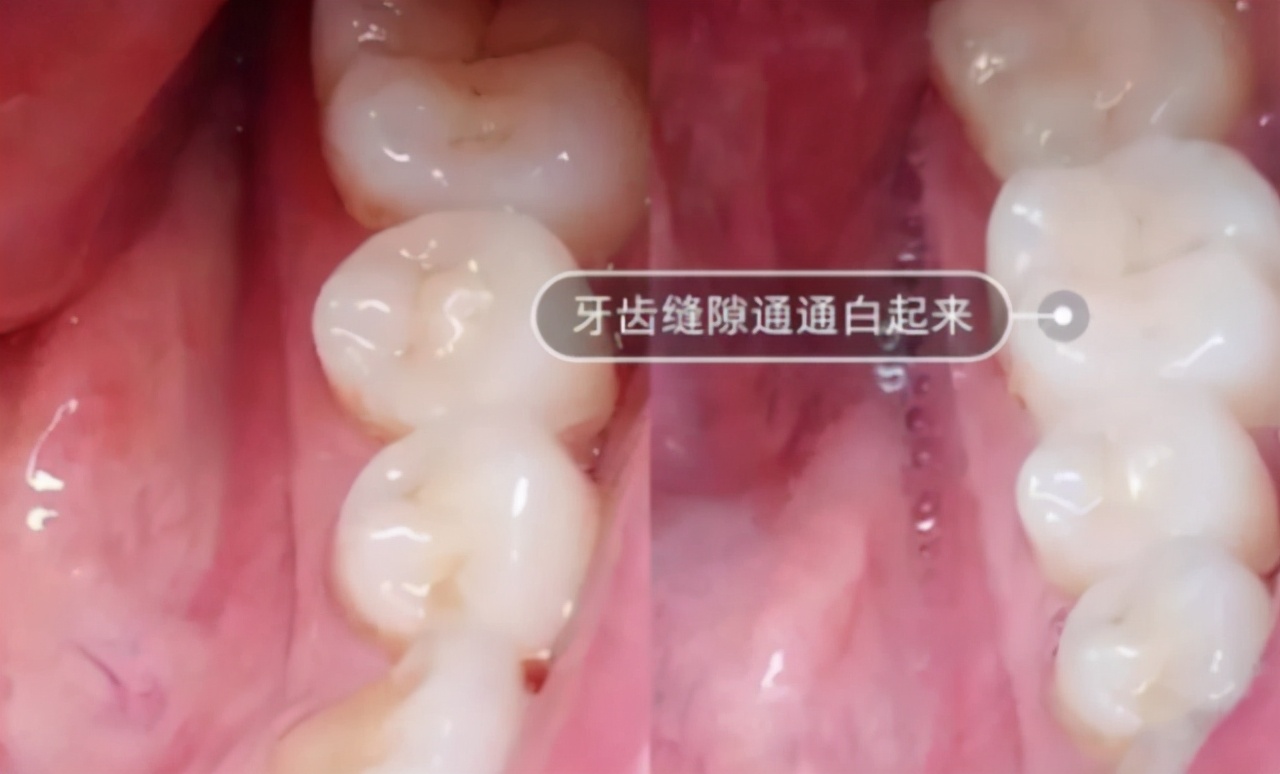 电动牙刷与普通牙刷的泡沫,用电动牙刷刷牙时怎么刷