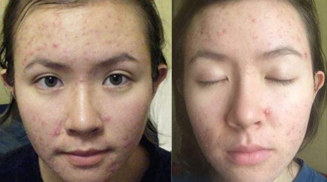 正品完美芦荟胶有祛疤功能吗,哪个牌子的芦荟胶祛痘好一点