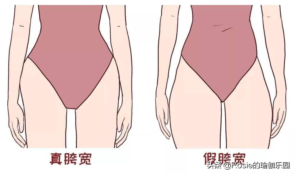 假胯宽怎么消除最有效,假胯宽是什么原因怎么治