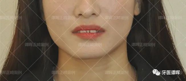 门牙前突牙齿不齐矫正案例分享,门牙和旁边牙齿不齐最快矫正方法