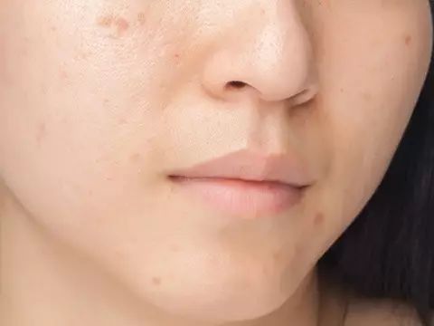 鼻子上痘印消不掉怎么办,青春期痘痘密集痘印消不掉怎么办