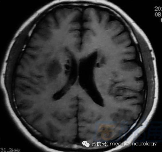 脑出血磁共振t1t2表现,10分钟记住脑出血核磁表现