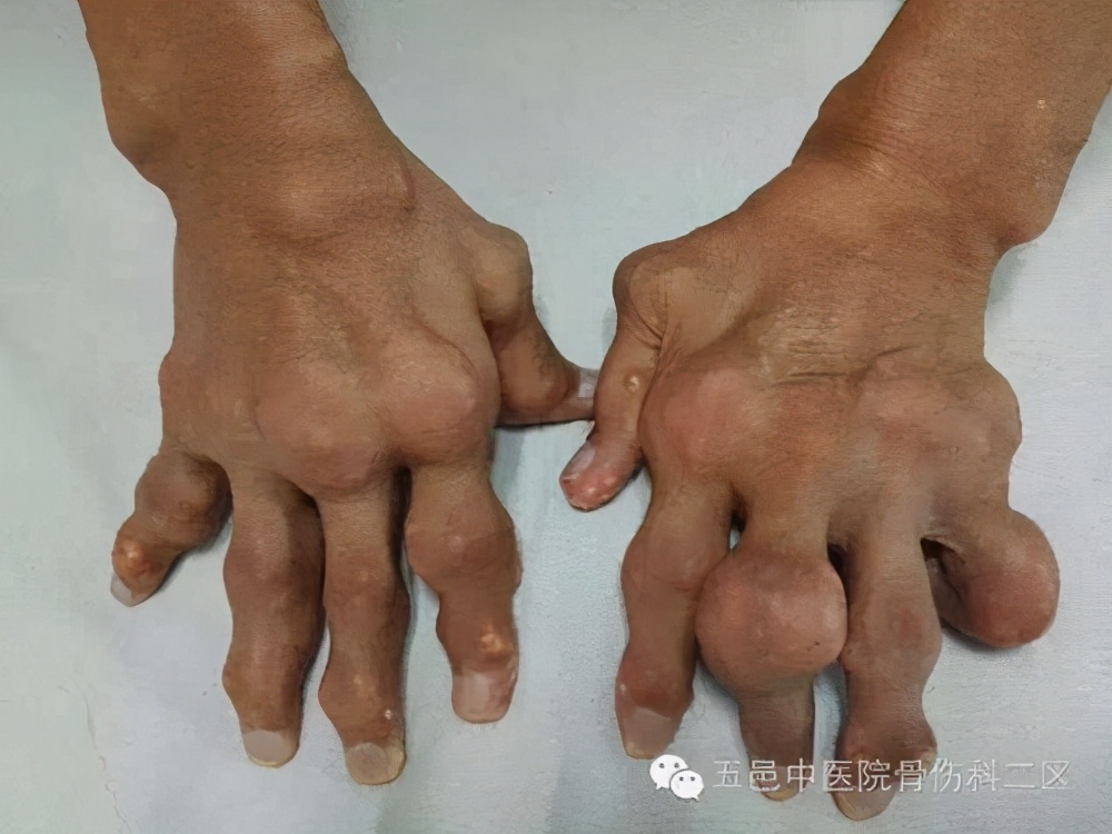 痛风发作缓解痛风的最有效的方法,痛风发作时如何快速缓解疼痛