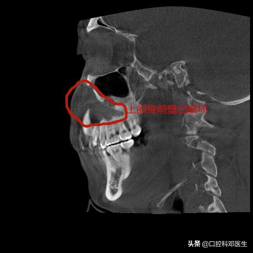 水平阻生埋伏牙真实拔除过程,埋伏阻生牙一辈子不拔行吗