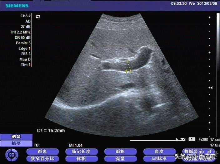 乙肝小三阳肝功能正常需要治疗吗,乙肝小三阳肝功能正常要注意什么