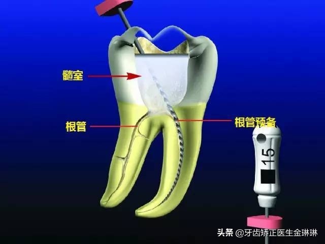 小蛀牙补牙,小蛀牙可以修复吗