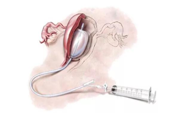 产后出血纱布填塞取出步骤,产后出血放置球囊操作记录