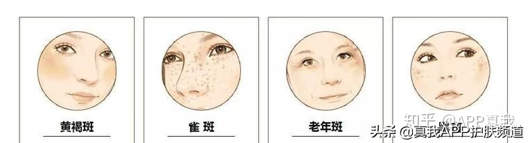 20岁女生可以祛斑吗,20岁的女生脸上有斑以及脸部暗淡