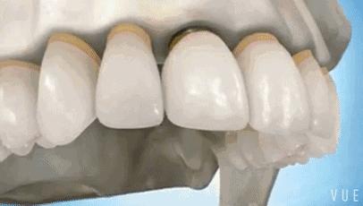 年龄大了牙齿松动掉落怎么办,小孩换牙牙齿松动掉落怎么扯掉