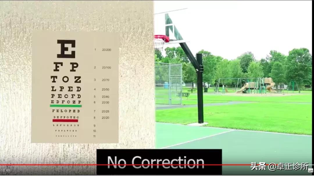 怎么按摩眼睛改善散光,怎么锻炼眼睛能改善散光