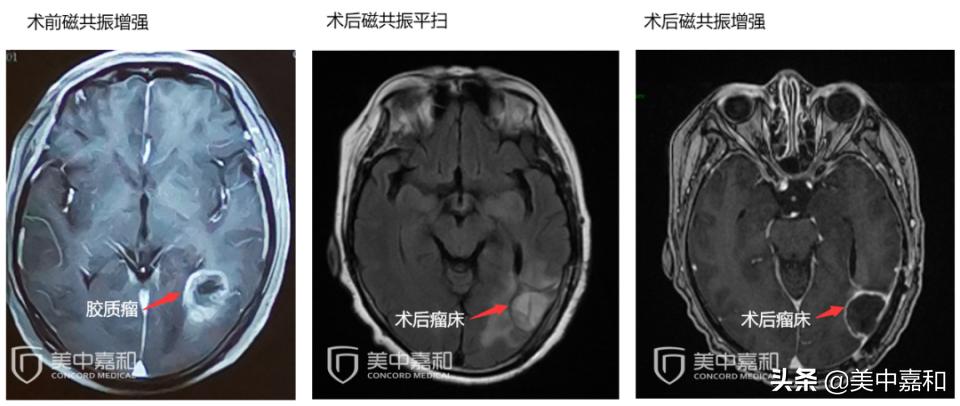 预后不良是不好的意思吗,预后差还有机会治愈吗