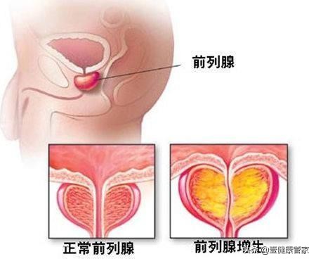 前列腺轻度肥大可怕吗,前列腺轻度肥大不治疗有什么后果