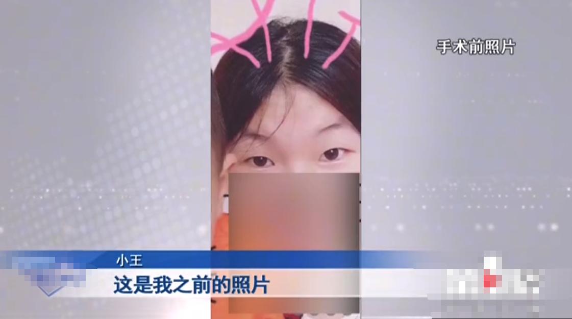 “老公骂我是怪物，要跟我离婚！”重庆女子三次割双眼皮却越割越丑，整容变“毁容”？女子：想死的心都有了