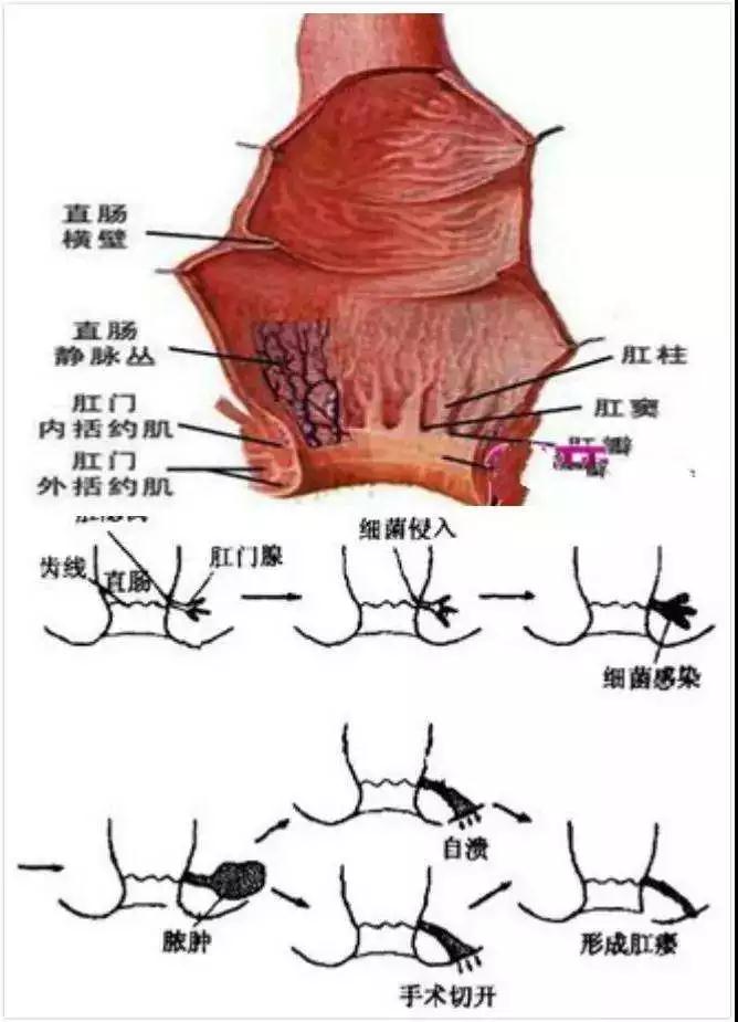 肛周脓肿误诊直肠癌,肛周脓肿误诊成内痔