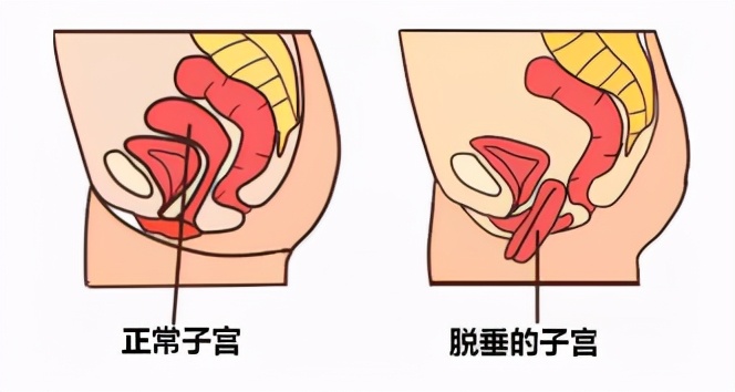 都安全小黄盒|尿湿裤子太尴尬了，产后妈妈如何盆底康复？