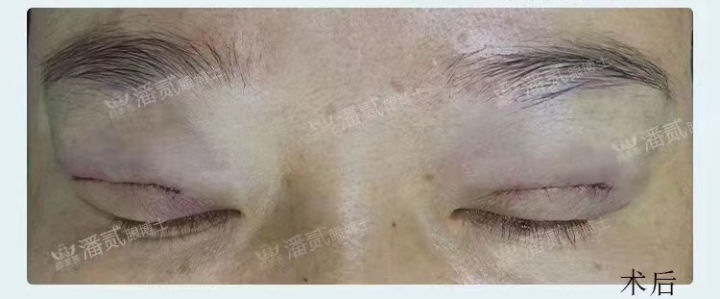 眼皮填充的脂肪凹凸不平怎么办,上眼皮凹陷填充脂肪有危险吗