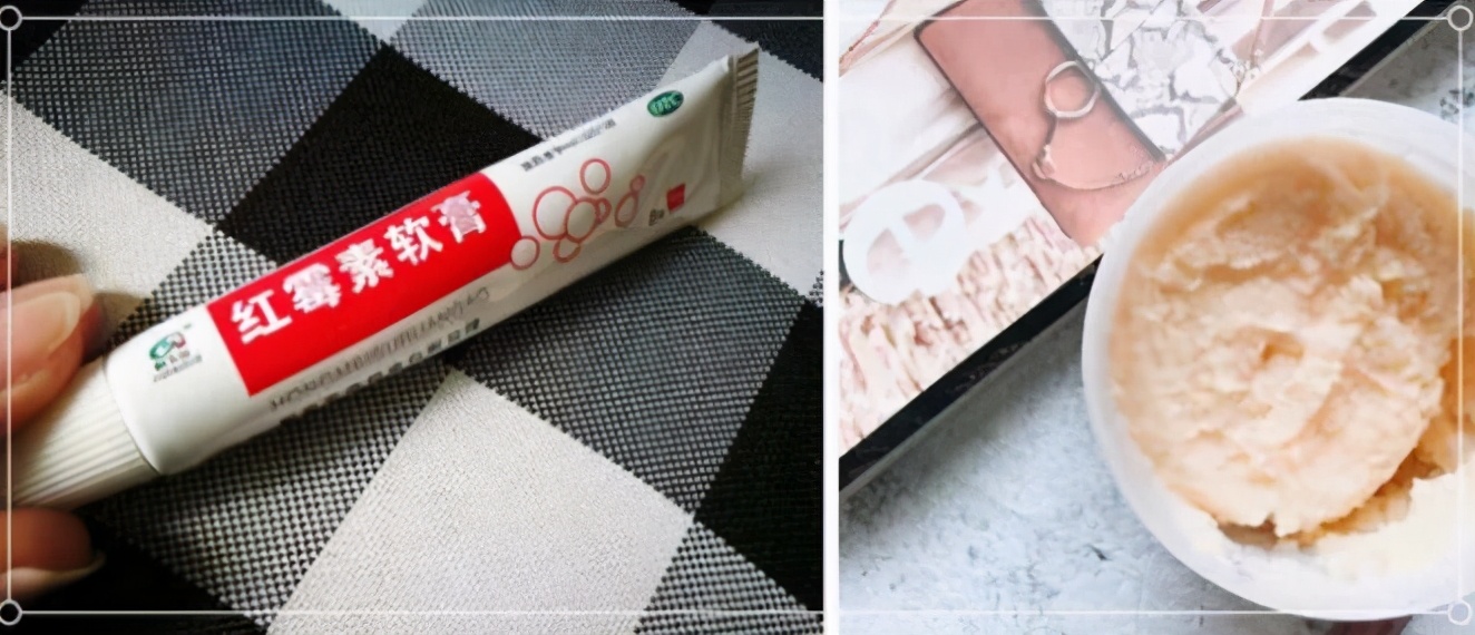 脸上有脂肪粒用什么方法去除,脸上脂肪粒最有效的方法