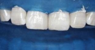 门牙缝可以补吗,为什么门牙有缝