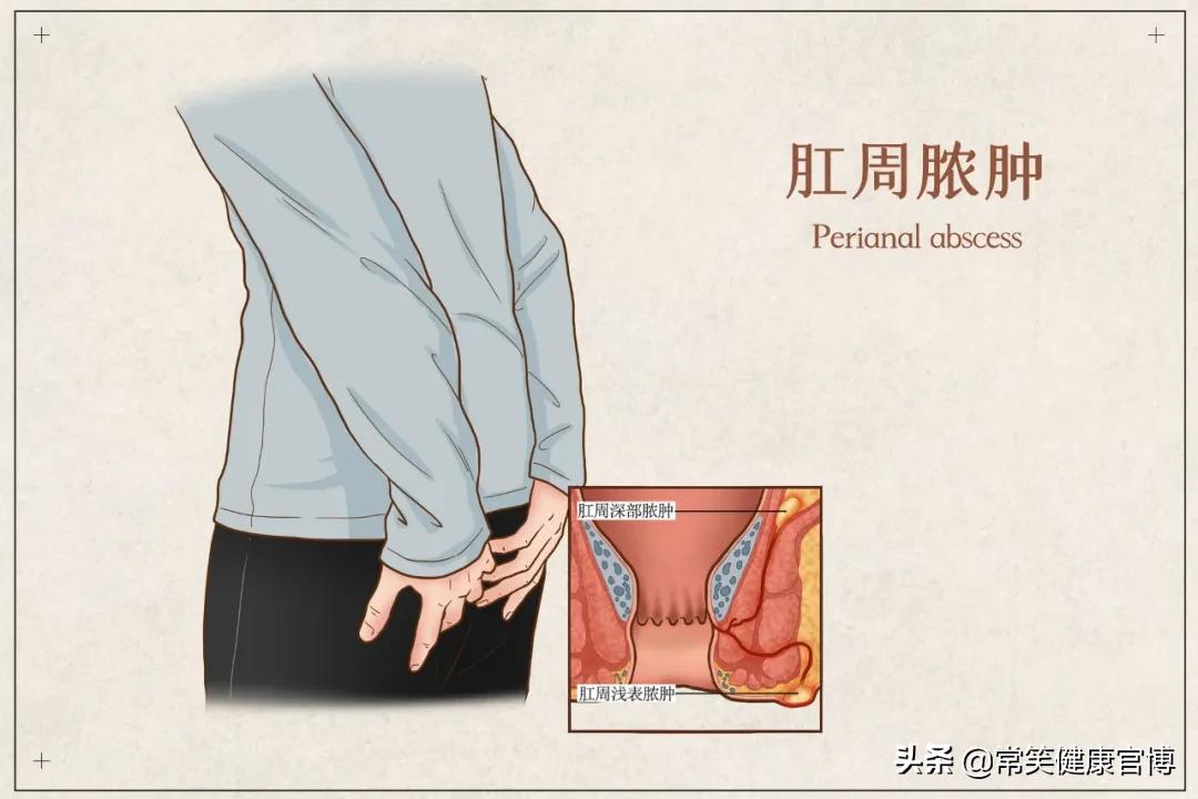 菊花脓肿,肛周脓肿跟痔疮的病症
