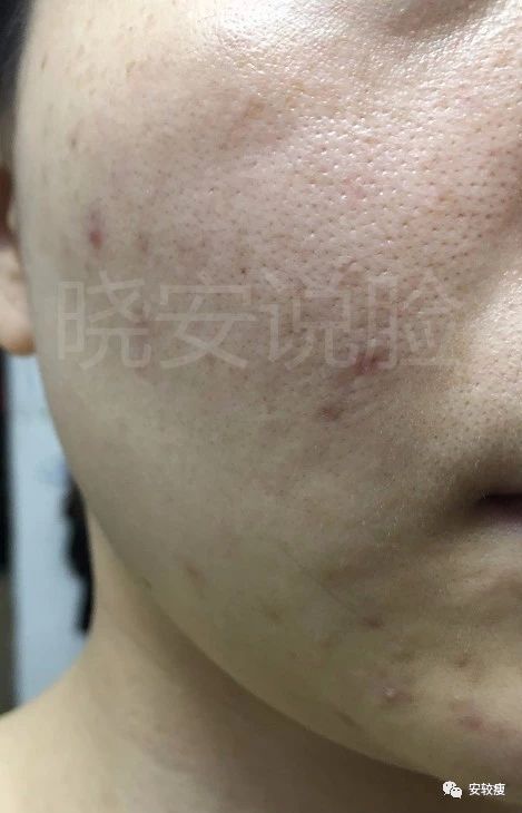 外油内干敏感痘肌怎么护肤,30岁油皮痘痘敏感肌怎么改善