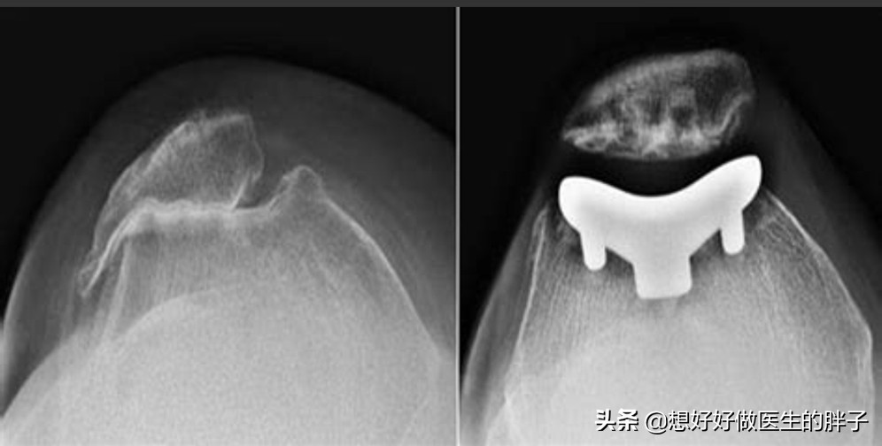 髌骨软骨损伤膝盖总是咔咔响,膝盖损伤后髌骨响是什么原因