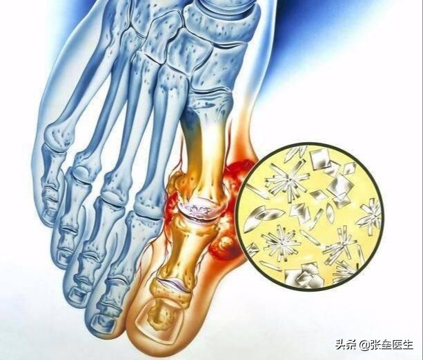 50%痛风患者无法工作和下地干活,在家突然痛风如何紧急减痛