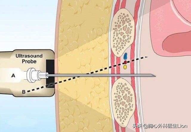 肺癌怎么检测早期或是晚期,肺癌晚期和早期的检测方法