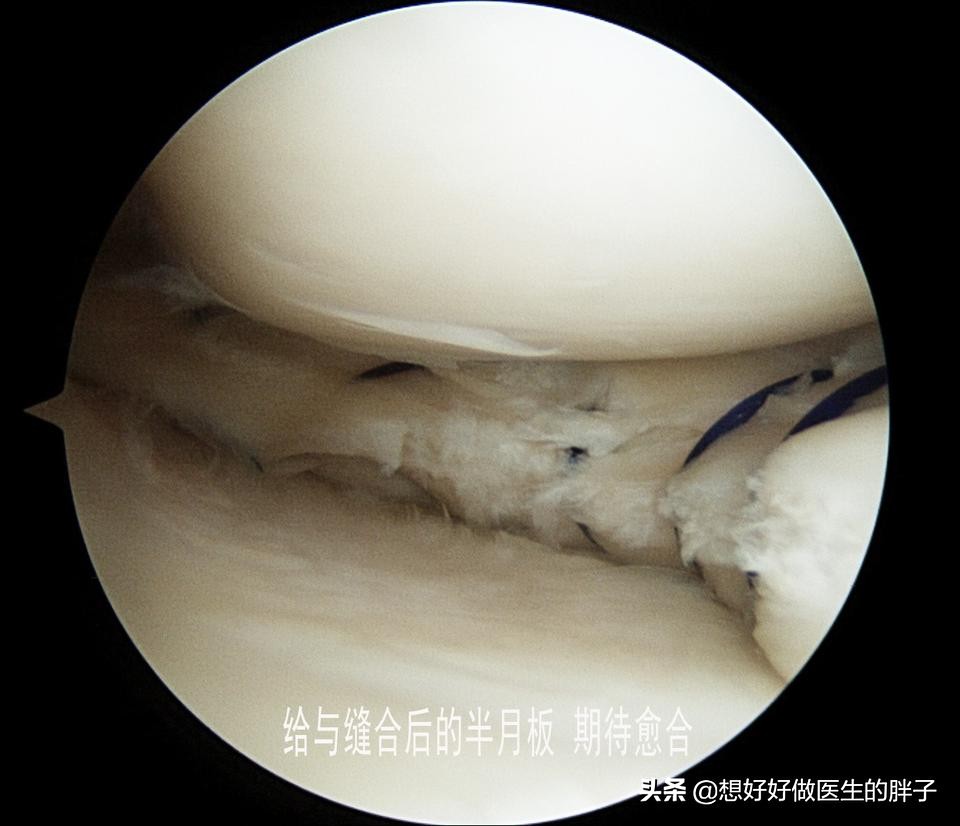 为什么足球运动员不会半月板受伤,足球运动半月板损伤