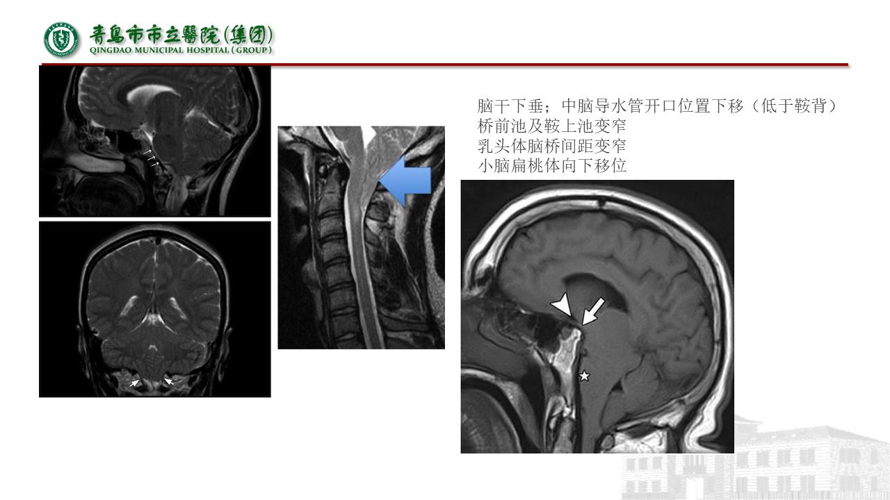 低颅压综合征耳闷,低颅压综合征吃什么药